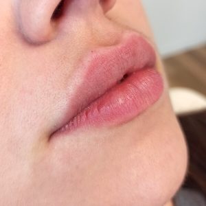 Hyaluron Lippen-aufspritze-Hyaluronsäure Aesthetiqua